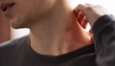 A bárányhimlő kockázatai és megelőzése felnőtteknél másodszor